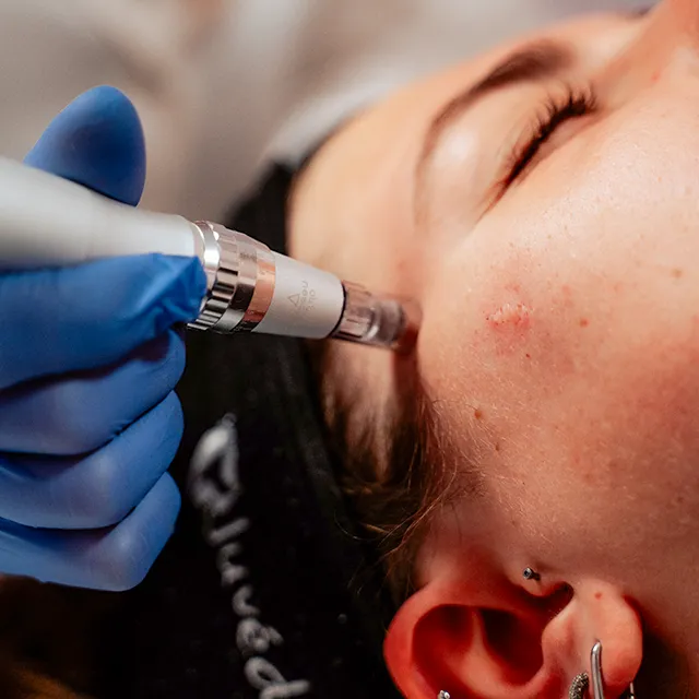 Micro Needling Behandlung