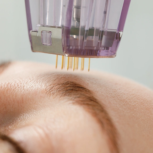 Micro Needling Behandlung